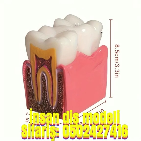 Human tooth model with caries - Tenderyard